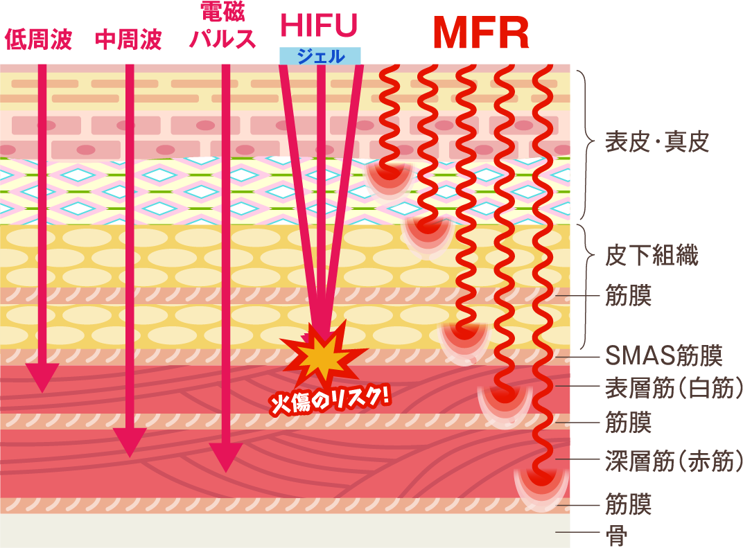 MFR図